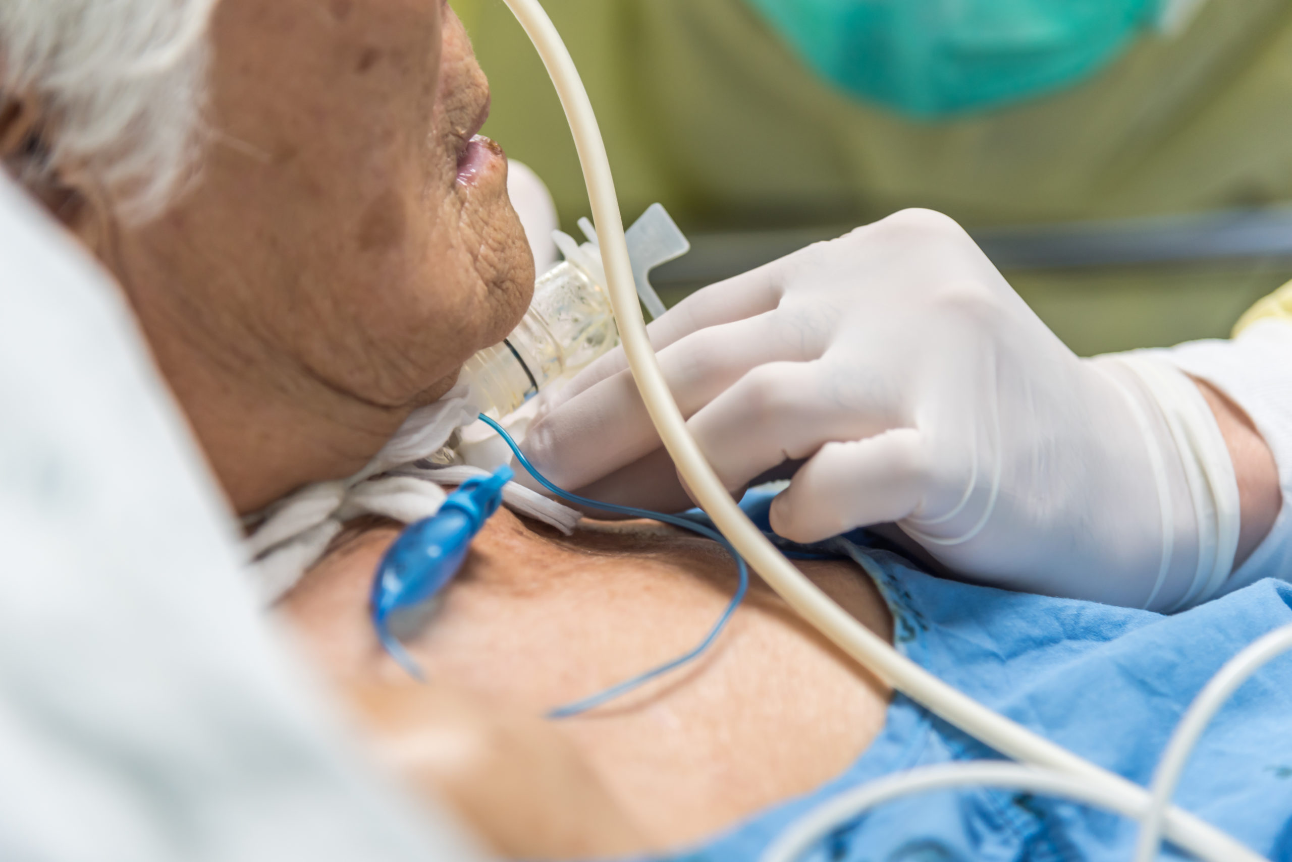 Patient with a tracheostomy and ventilator in hospital