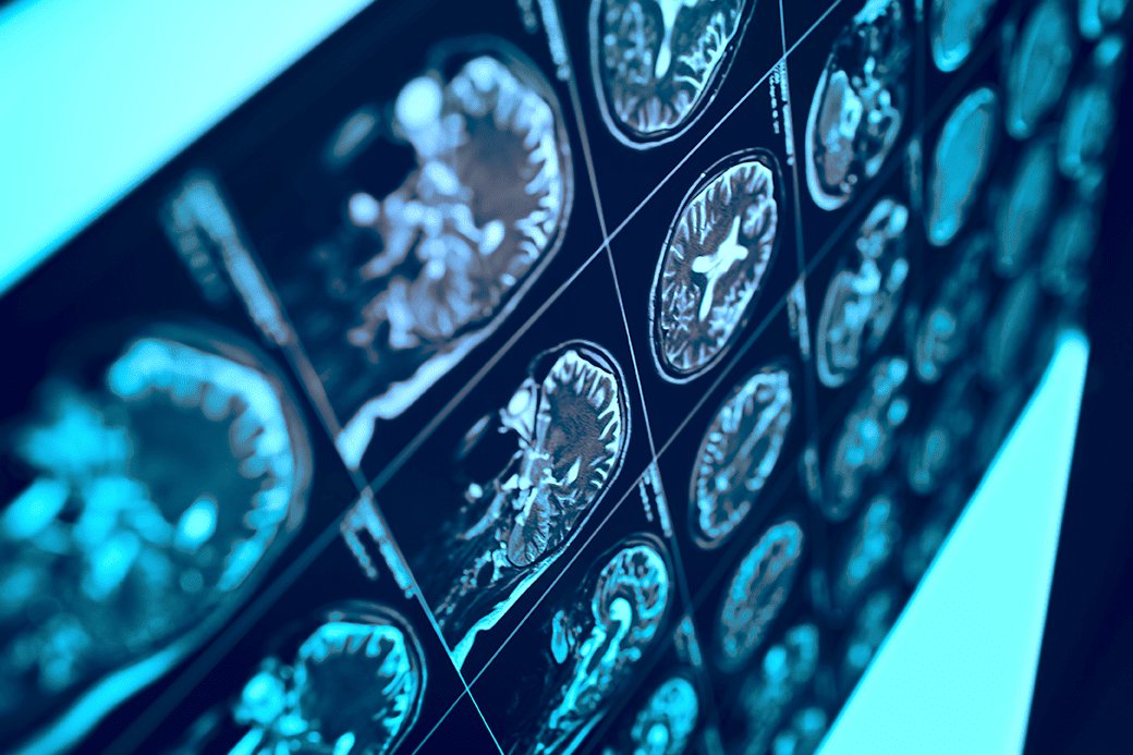 Photo showing brain scans on a lightbox